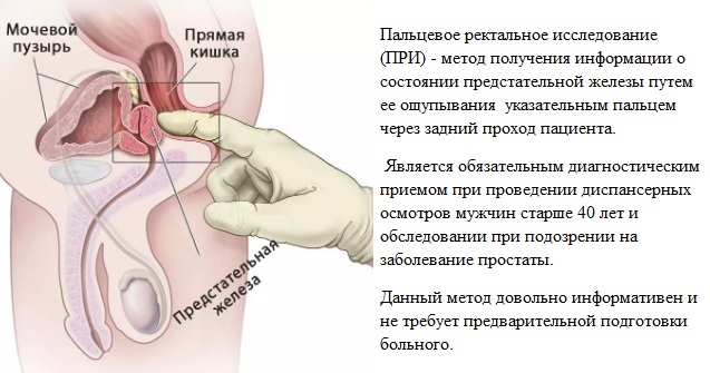 пальцевое ректальное исследование простаты