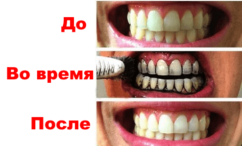 Отбеливание зубов активированным углем